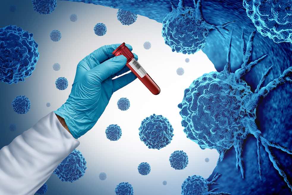 Multi-cancer early detection blood test speeds up cancer diagnosis