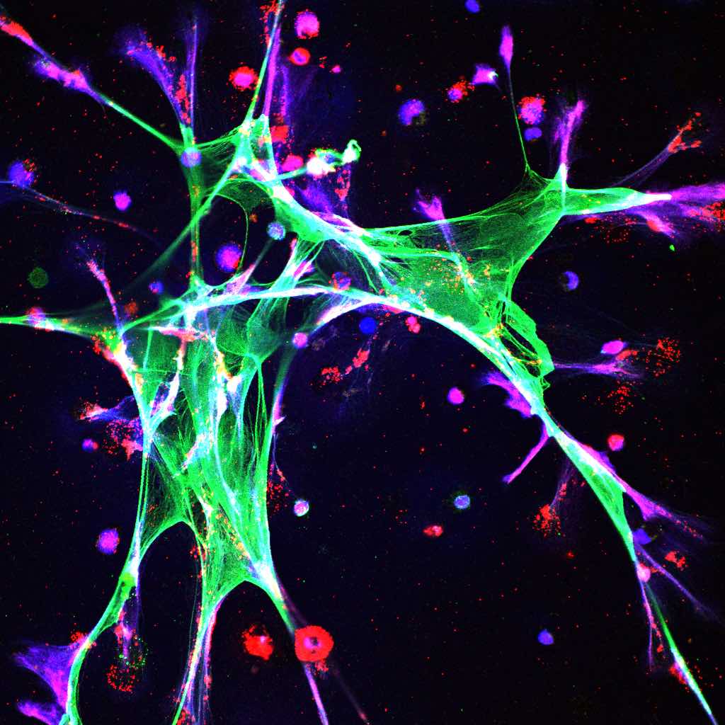 Mechanisms linking chronic stress to raised metastasis risk discovered ...
