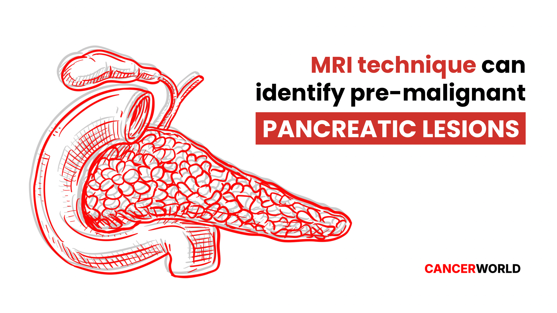 MRI technique can identify pre-malignant pancreatic lesions